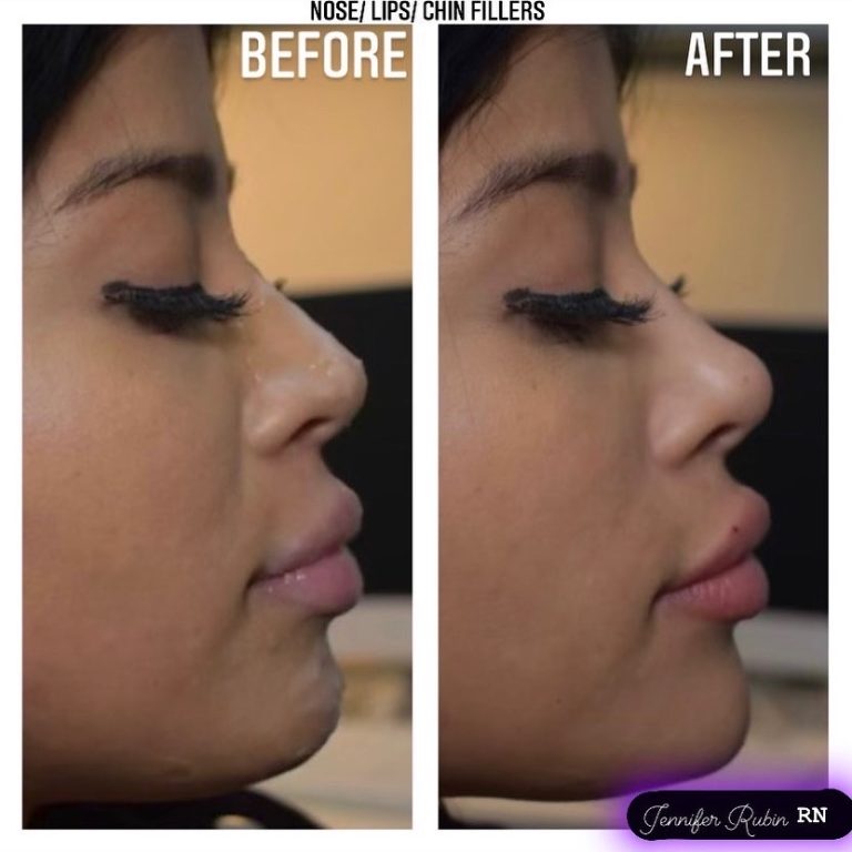 Fillers Before & After Gallery Patient 122596981 Image