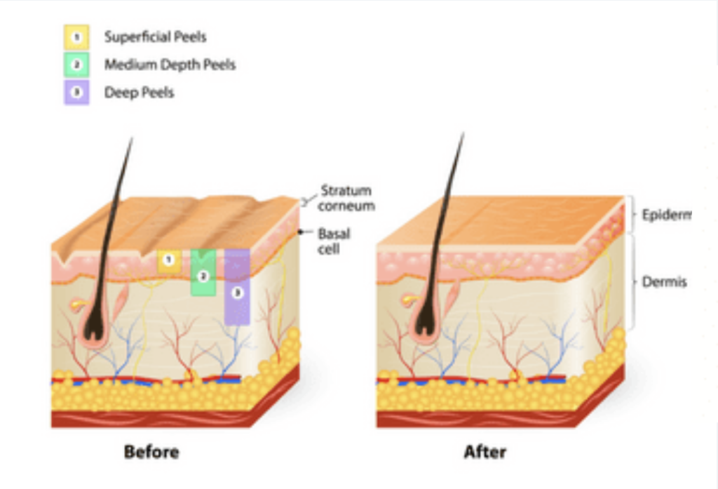 Chemical Peels