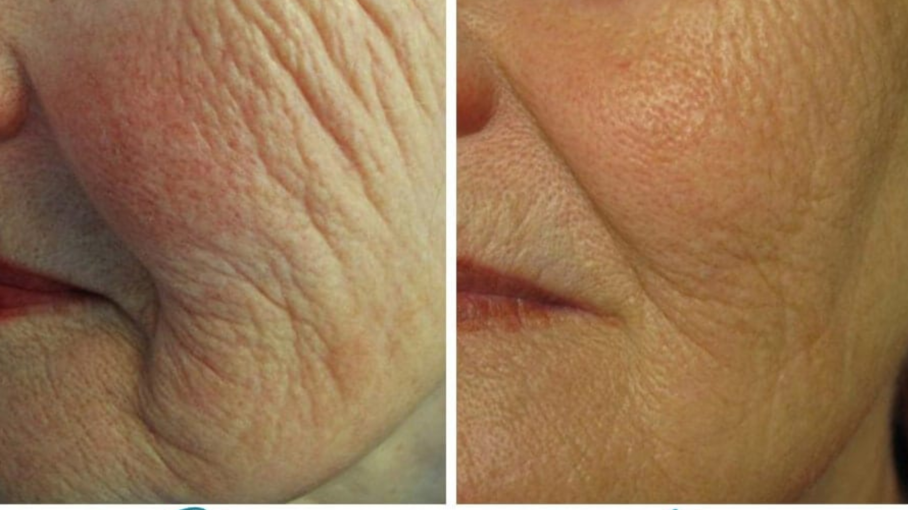How Does Profound RF Tighten Skin