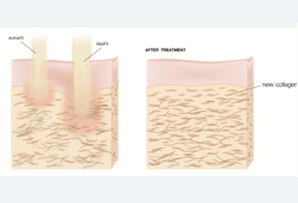 Laser Resurfacing