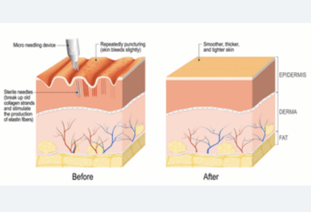 Microneedling