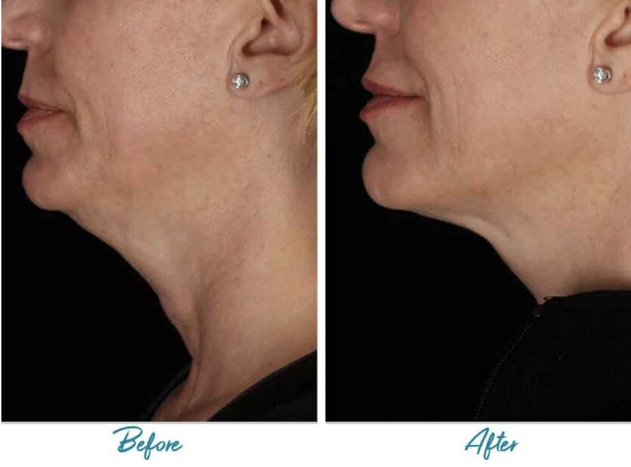 Profound RF Double Chin Reduction