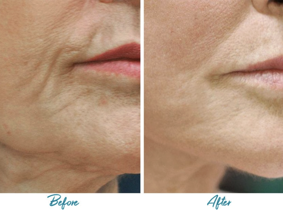 Profound RF Non Surgical Skin Tightening