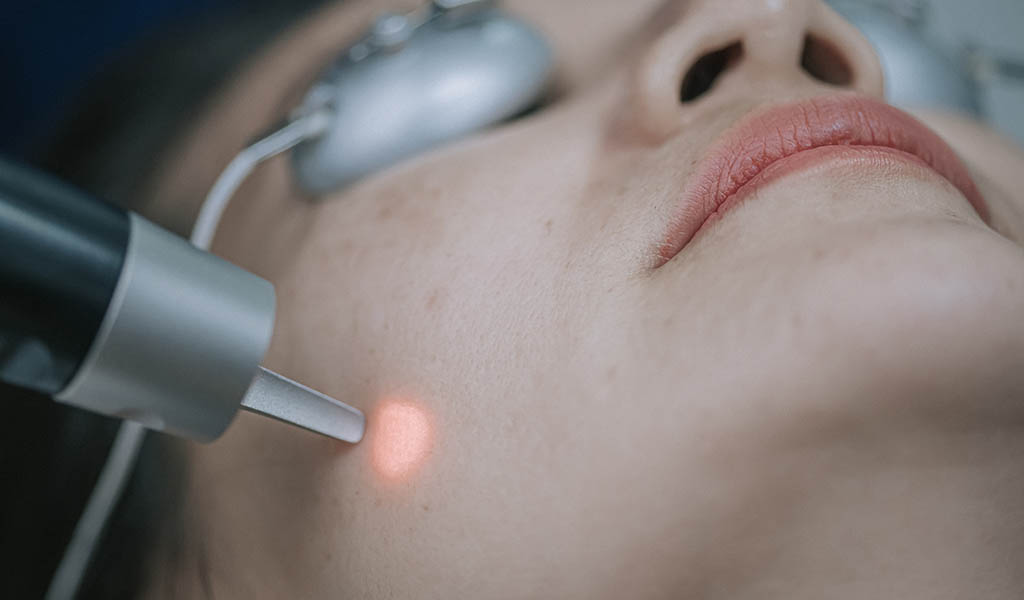 How To Get Rid Of Post-Acne Hyperpigmentation?