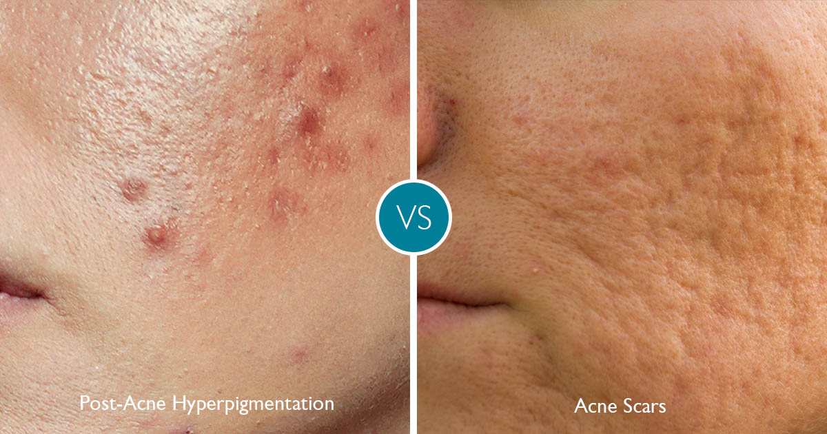 Post Acne Hyperpigmentation vs. Scarring