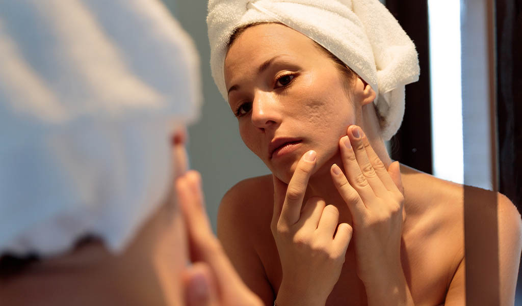 What Is Acne Scarring