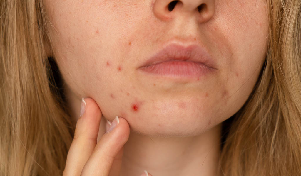What Is Post-Acne Hyperpigmentation