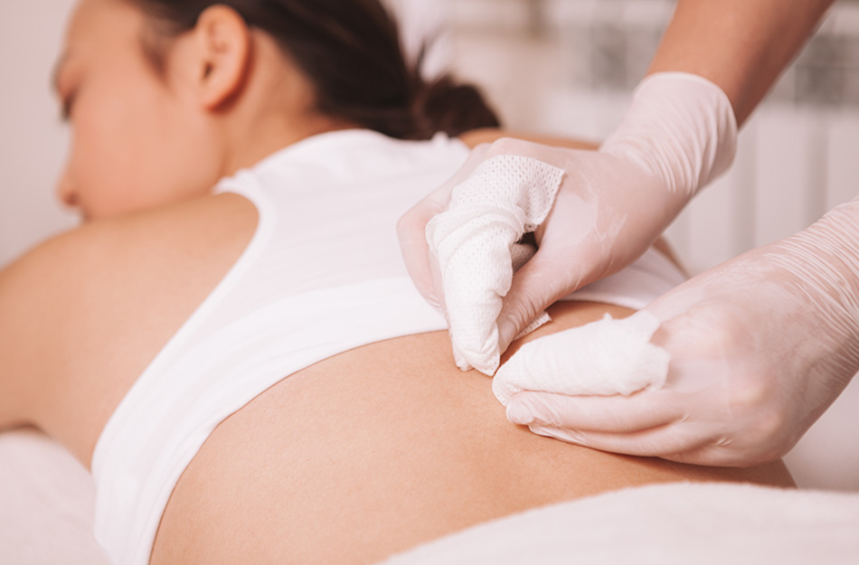 Chemical Peels