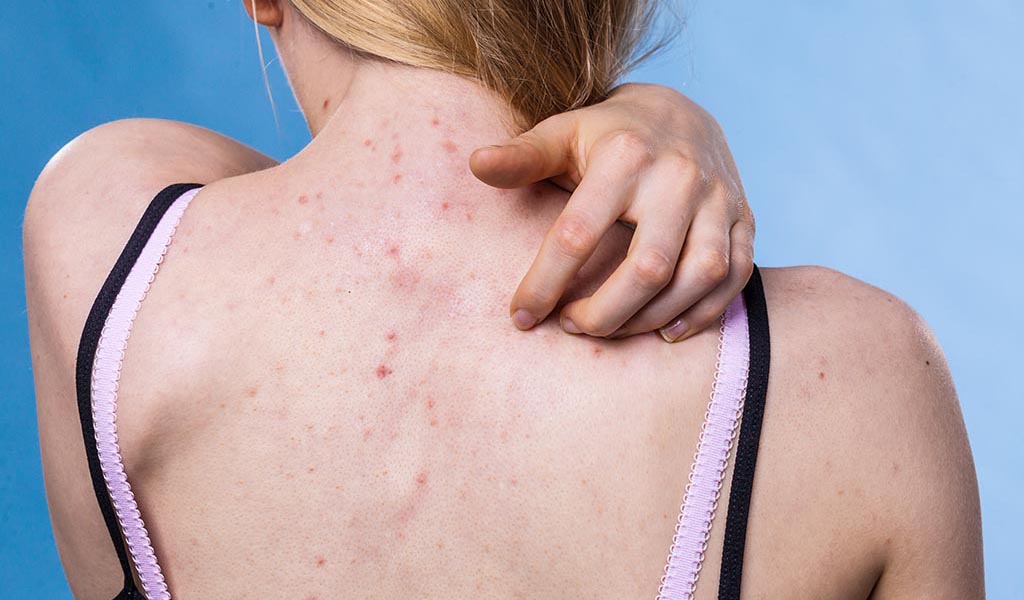 Back Acne Causes