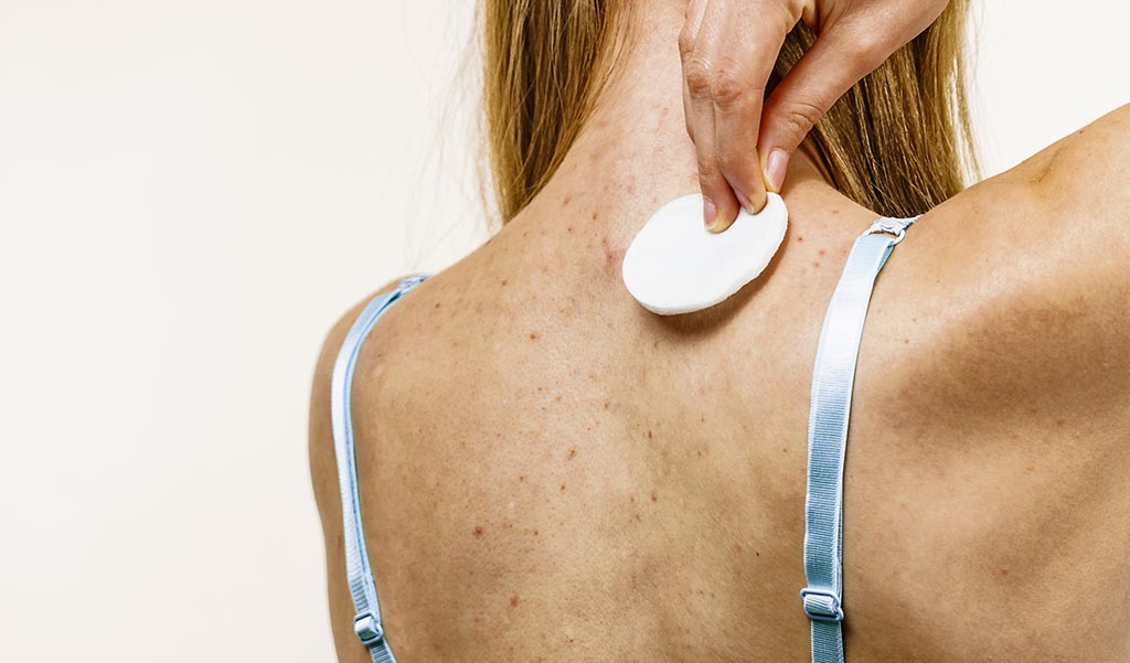 Back Acne Treatment