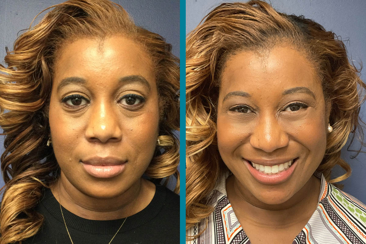 Blepharoplasty 1