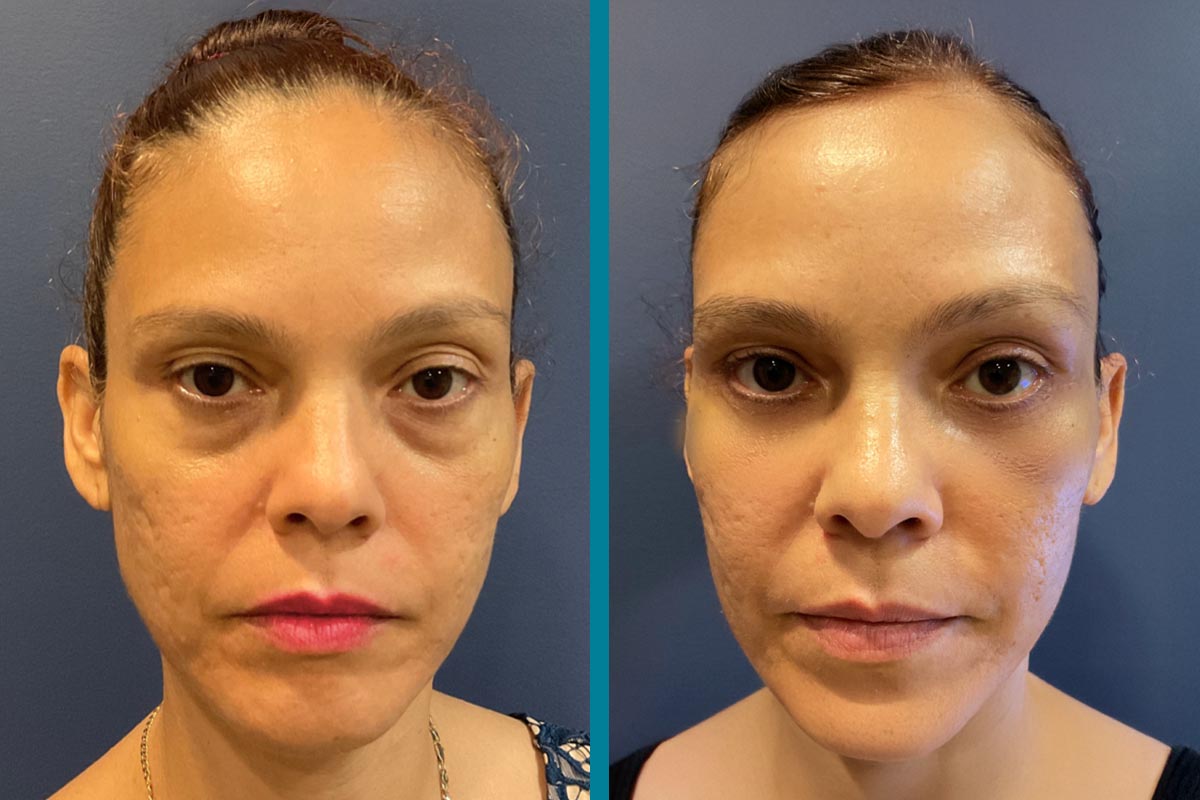 Blepharoplasty 5