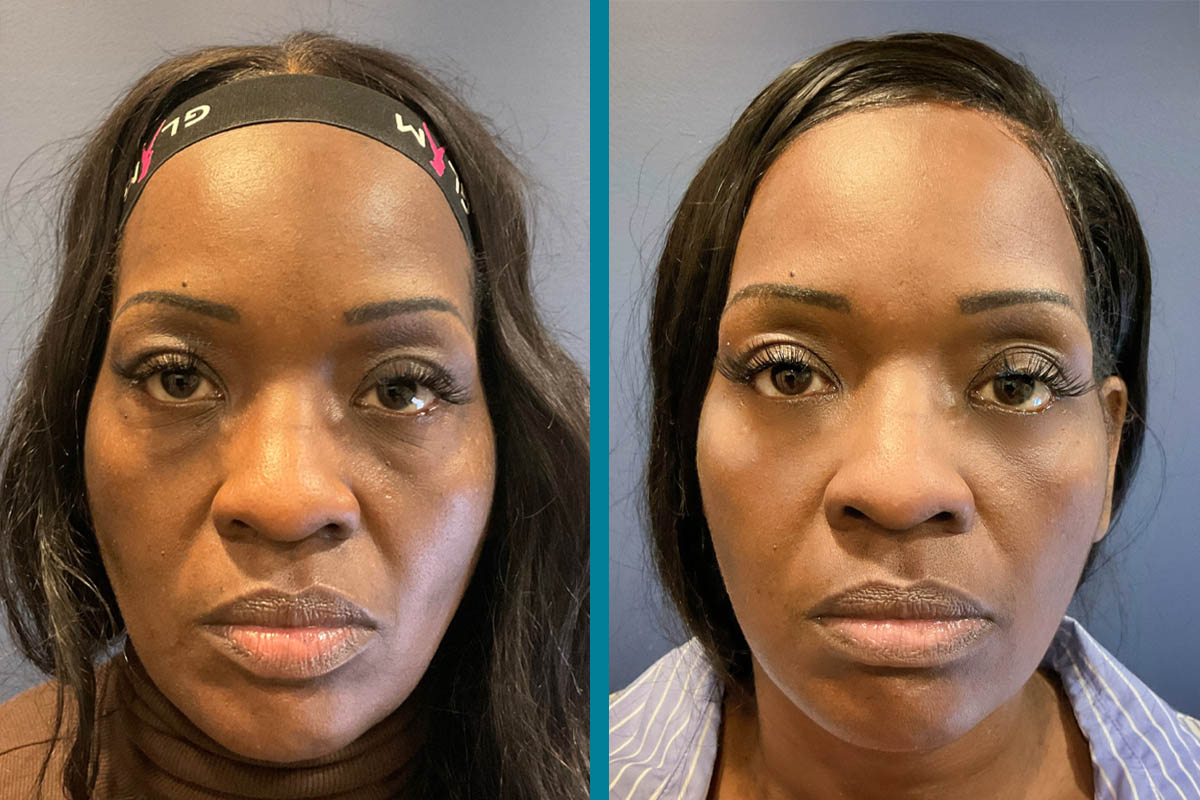 Blepharoplasty 6