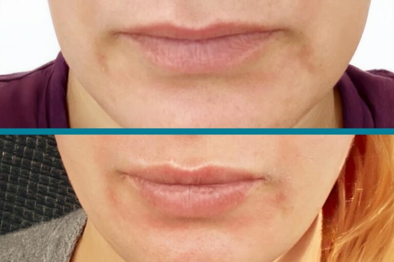 Fillers Before & After Gallery Patient 122596979 Image