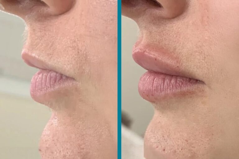 fillers before after gallery patient 122596980 image