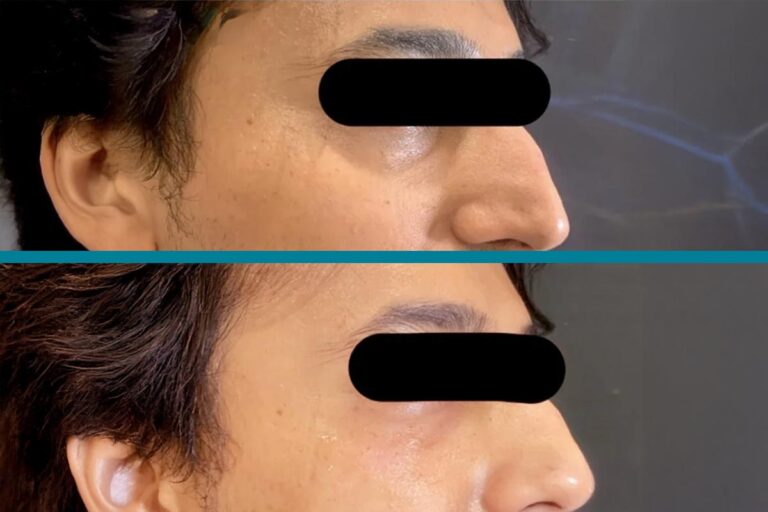 Fillers Before & After Gallery Patient 122596982 Image