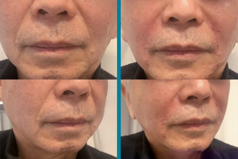 Fillers Before & After Gallery Patient 122596984 Image
