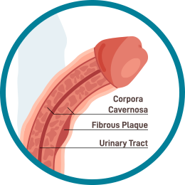Peyronie’s Disease (Penile Curvature)