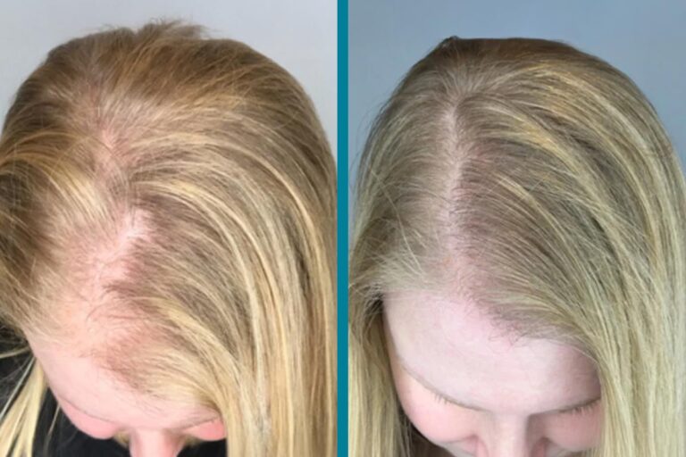 PRP Hair Loss Treatments Before & After Gallery Patient 18616195 Image