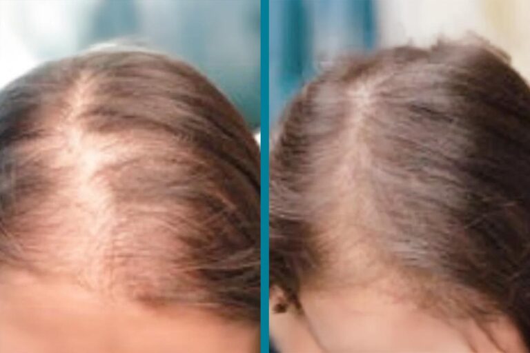 PRP Hair Loss Treatments Before & After Gallery Patient 18616197 Image
