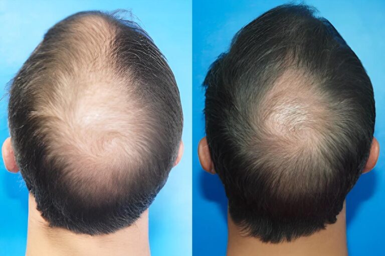 PRP Hair Loss Treatments Before & After Gallery Patient 18616198 Image