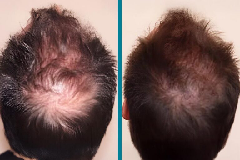 PRP Hair Loss Treatments Before & After Gallery Patient 18616199 Image