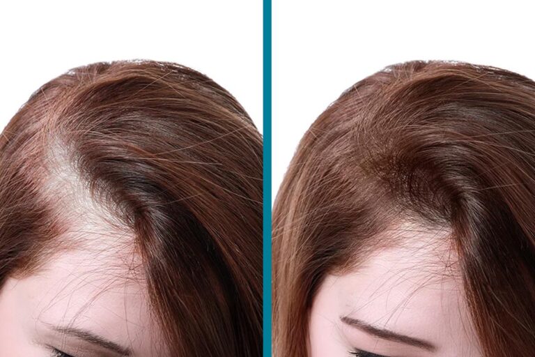 PRP Hair Loss Treatments Before & After Gallery Patient 18616200 Image