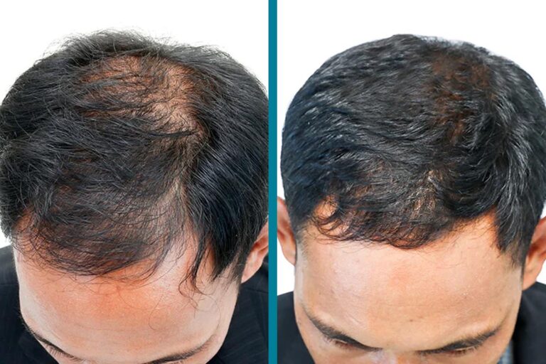PRP Hair Loss Treatments Before & After Gallery Patient 18616201 Image