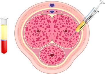 Targeted PRP Injections