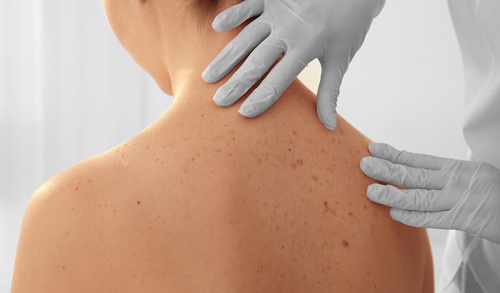 The Most Common Causes for Back Acne
