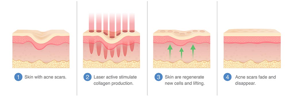 Acne scars treatment by laser