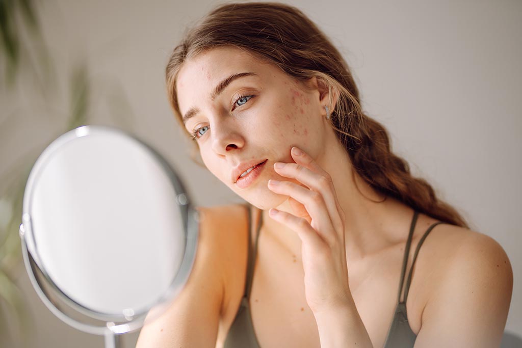 How to Choose the Best Acne Scar Treatment for Your Skin Type