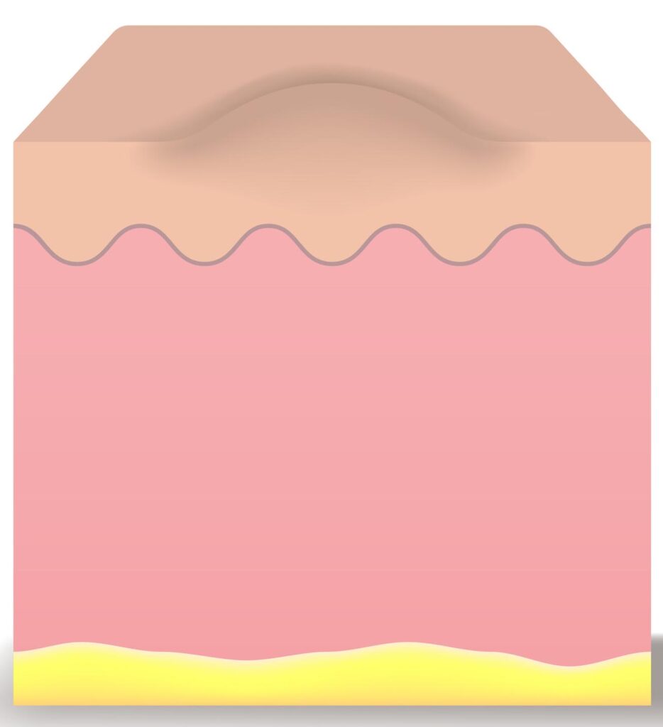Hypertrophic and Keloid Scars