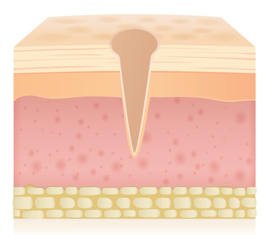 Ice Pick Scars