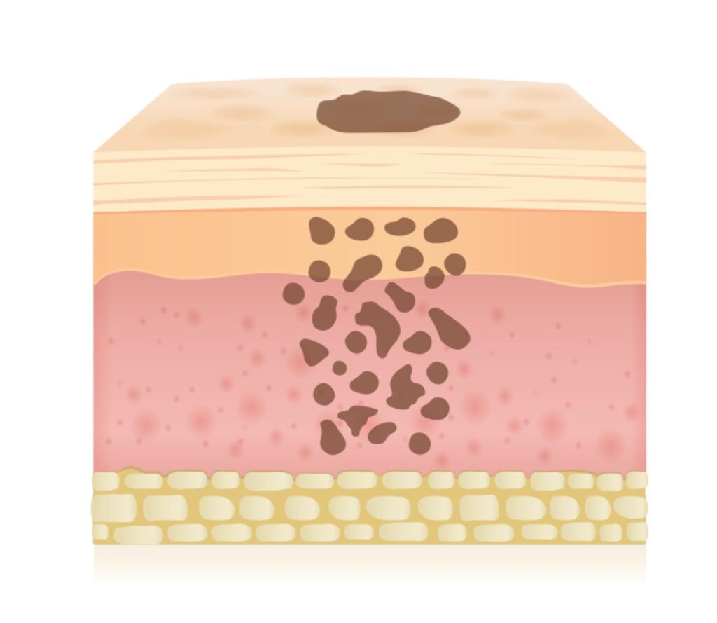 Post-Inflammatory Hyperpigmentation (PIH)