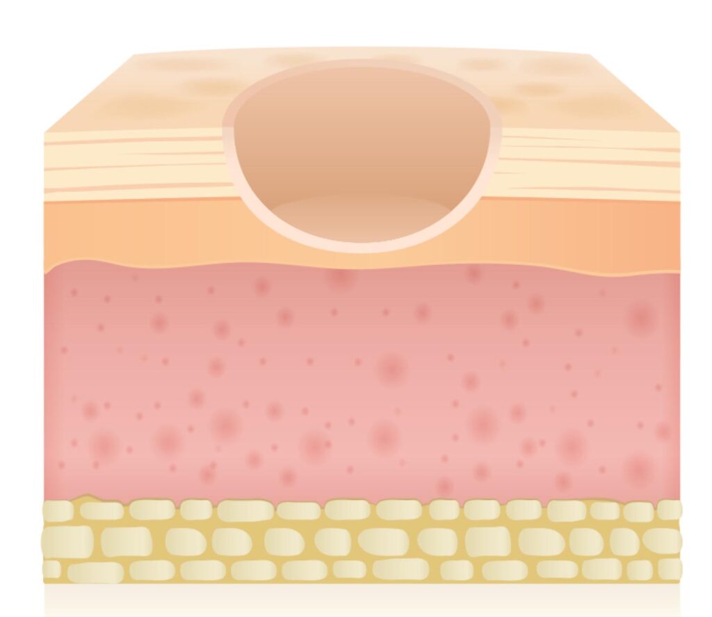 Rolling Scars