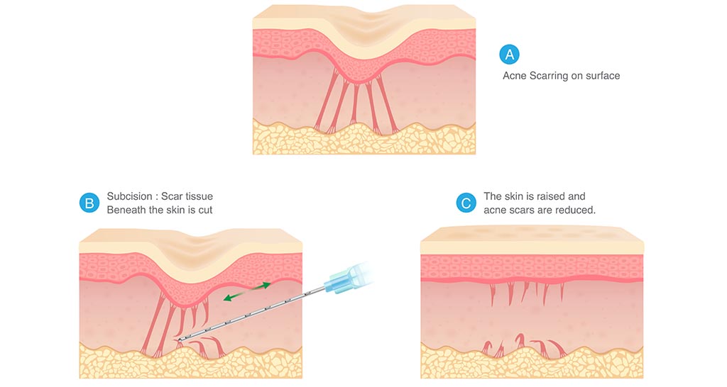 What is the best treatment for acne scars?
