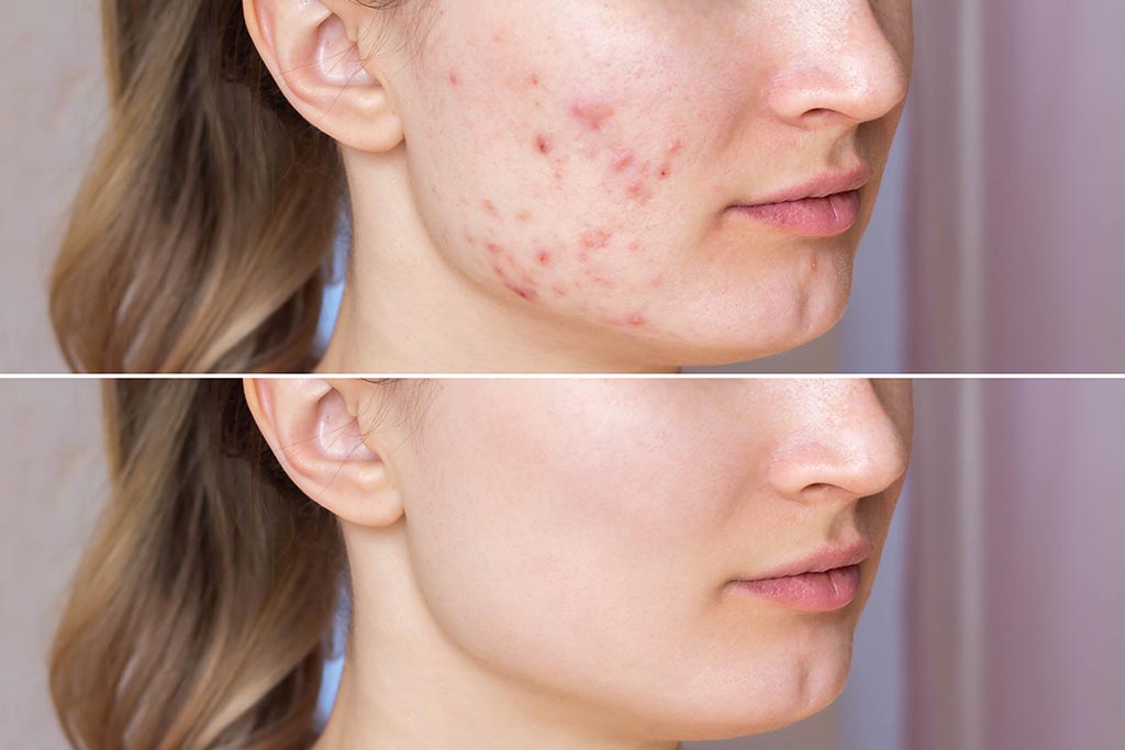 Why Acne Scars Need Personalized Treatment