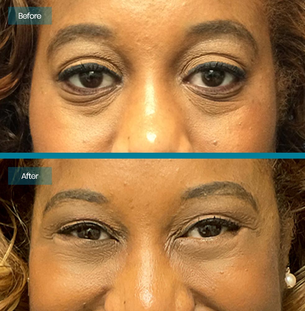 Blepharoplasty 1