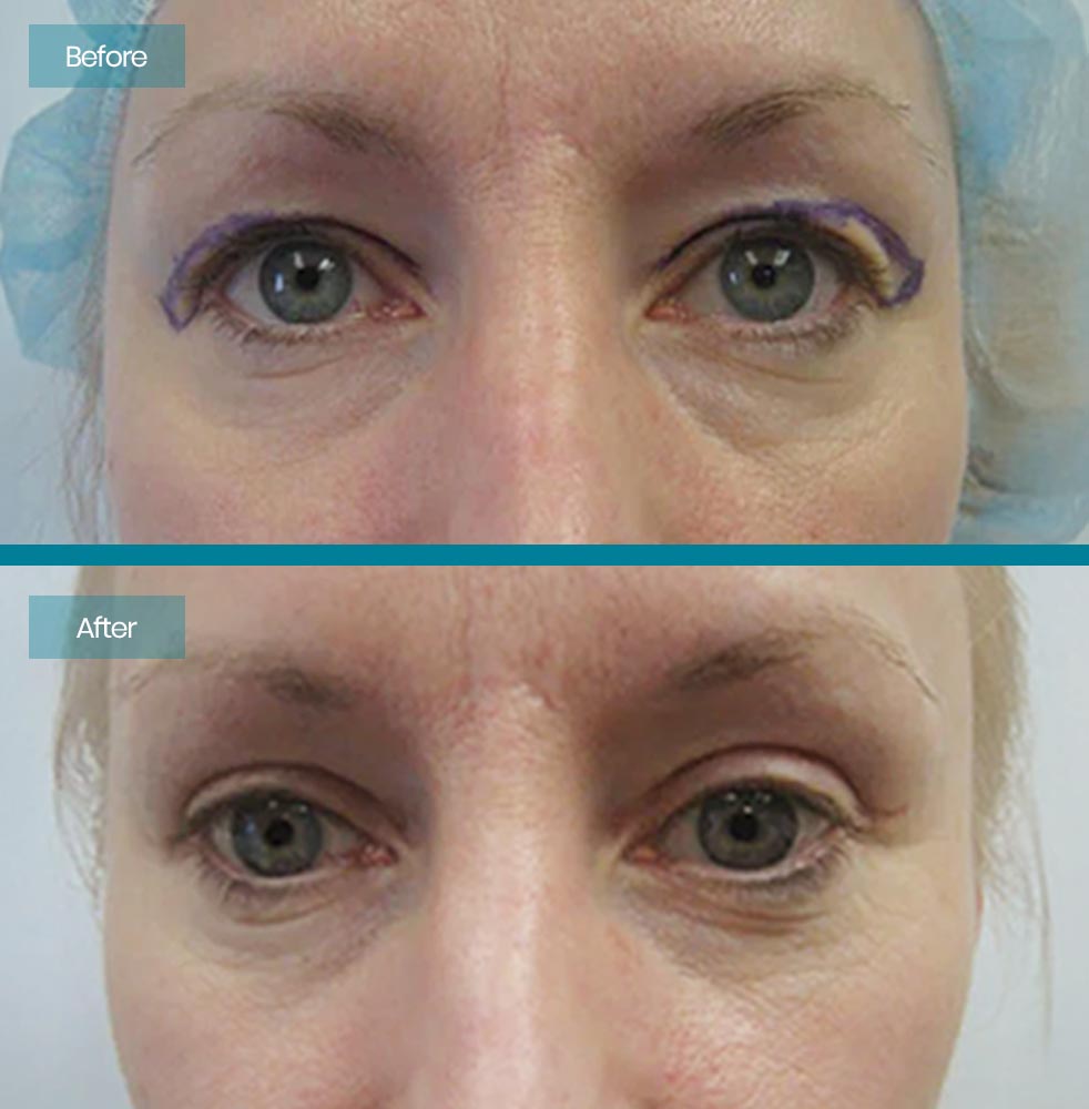 Blepharoplasty 2