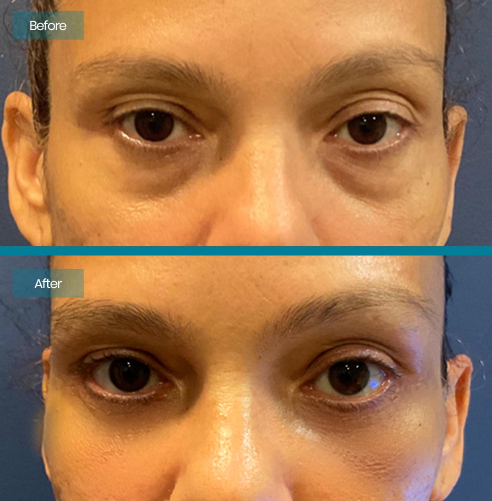 Blepharoplasty 4