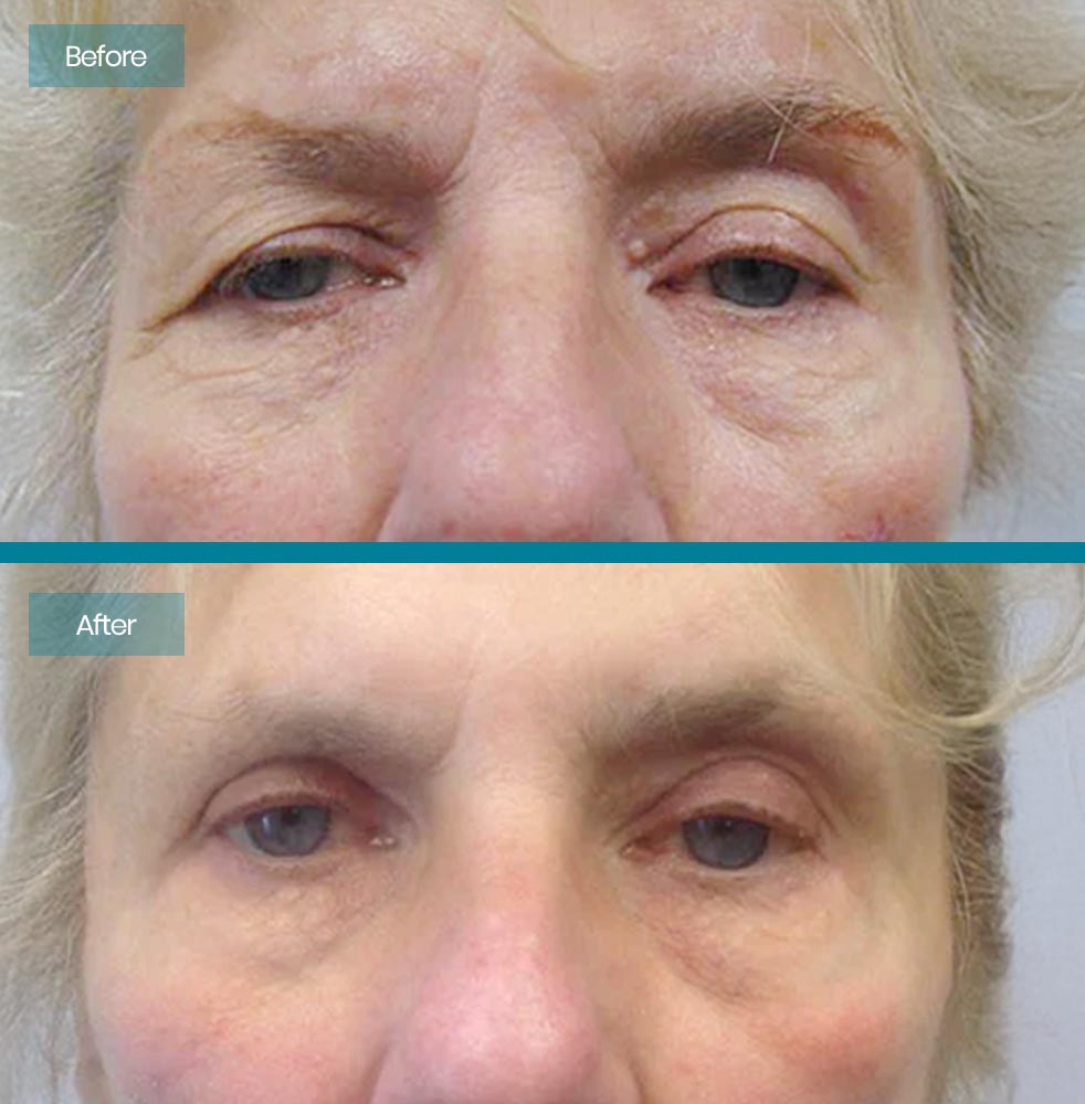 Blepharoplasty 5