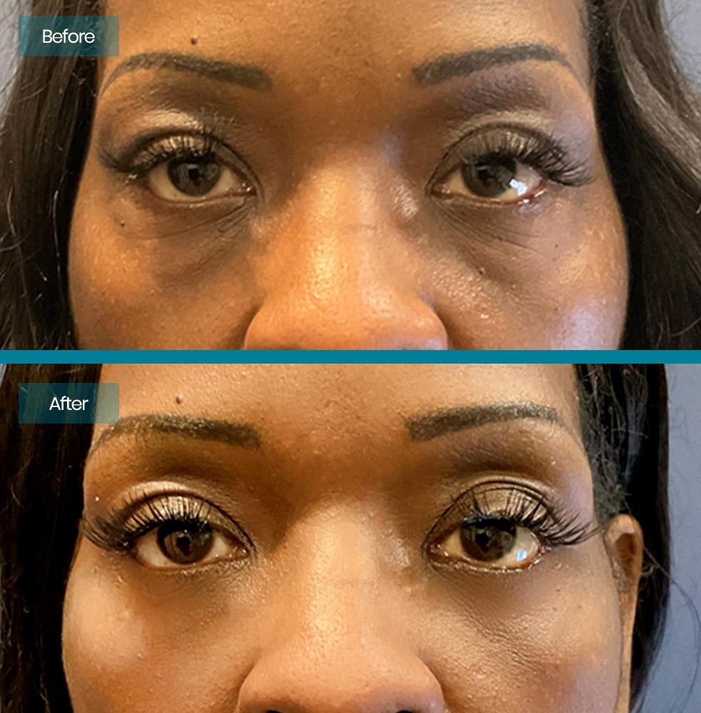 Blepharoplasty 6