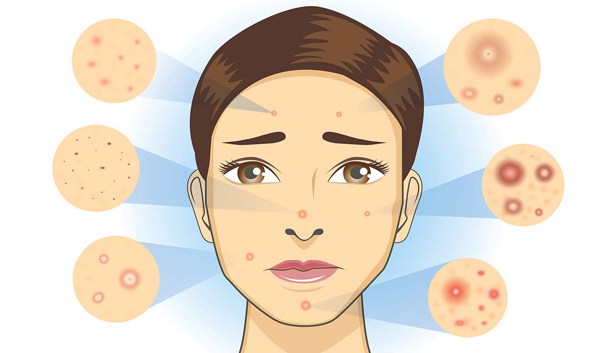 What Are The Different Types Of Acne Scars