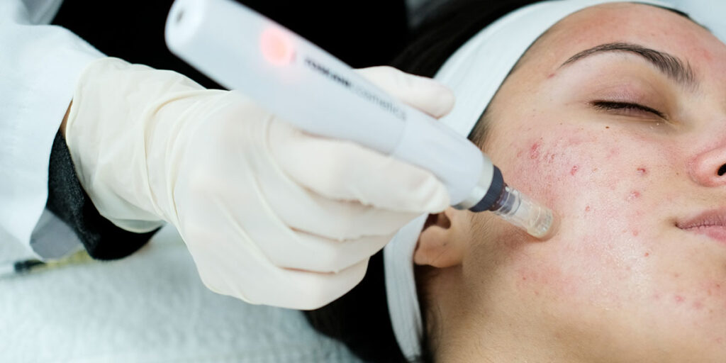 Other Treatment Options for Acne Scars