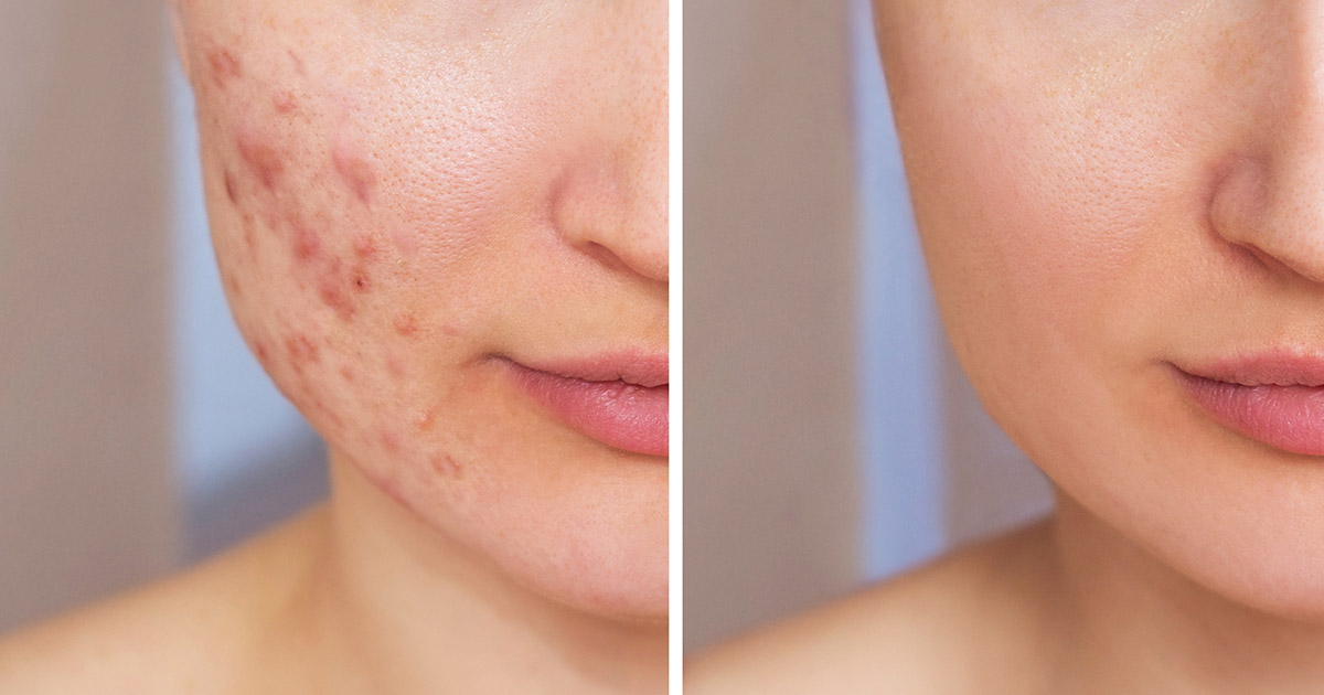 CO2 laser facial cost