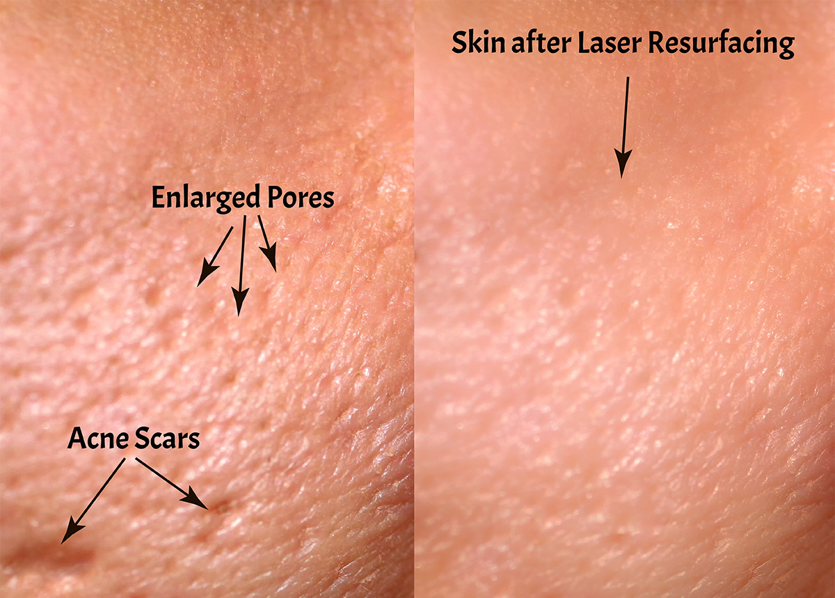 fractional CO2 laser cost