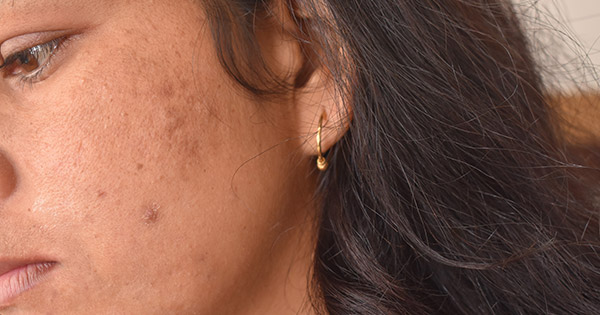 Dark Acne Scars