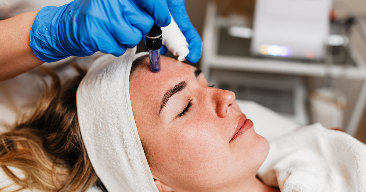 How to Get Rid of Deep Acne Scars