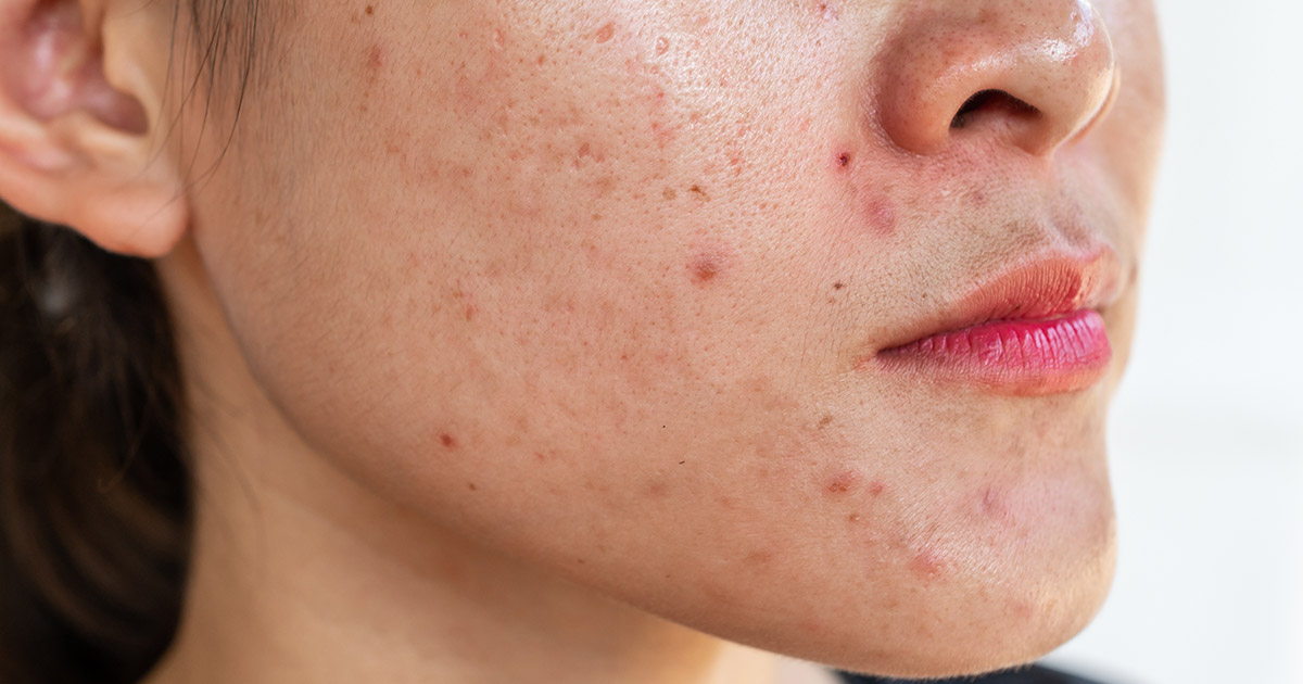 How to Get Rid of Red Acne Scars Fast